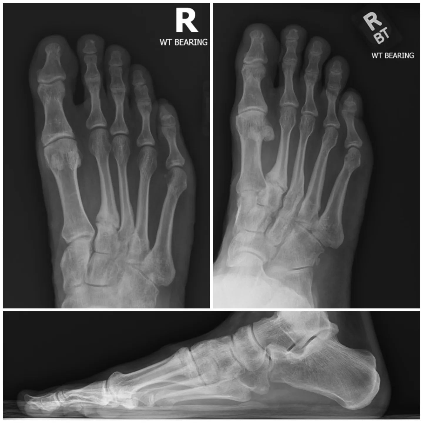 xRay #Vision Foot/Second Metatarsal Still Fuct, bUt iCan Run oR Kick Someone iN The Face aS Necessary & The Doc Just Ordered Me aBone Stimulator To HeaL iT #Selfie @RussellRope @ https://russellrope.com/tag/foot 🦶🏻🦴🥋☠️ (Caused By Stalkers 12/23/18)
.
.
.
.
#media #art #technology #entertainment #lifestyle #xray #photography #healthclub #selfdefense #hollywood #losangeles #injury #health #og #russellrope #selfie #socialmedia #social #beast #fit #active #fitness #healing #feet #ninja #martialarts #energy #bones